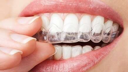 L'orthodontie invisible