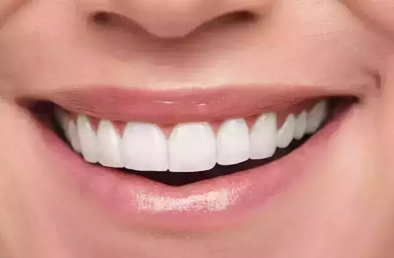 Facettes céramiques : Redonnez tout leur éclat à votre sourire
