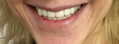 Réhabilitation du sourire