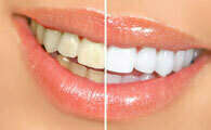 Le blanchiment des dents
