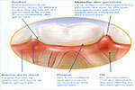 Qu'est-ce que la maladie des gencives ?