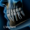 implant