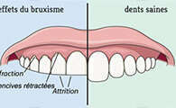 Bruxisme