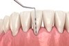 Soins des gencives Paris 15 - Dr Feredj