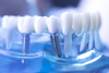 Les implant Paris 15 - Dr Feredj