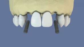 Agénésie des incisives : la solution des implants dentaires