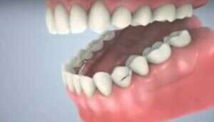 Prothèse dentaire partielle (partiel)