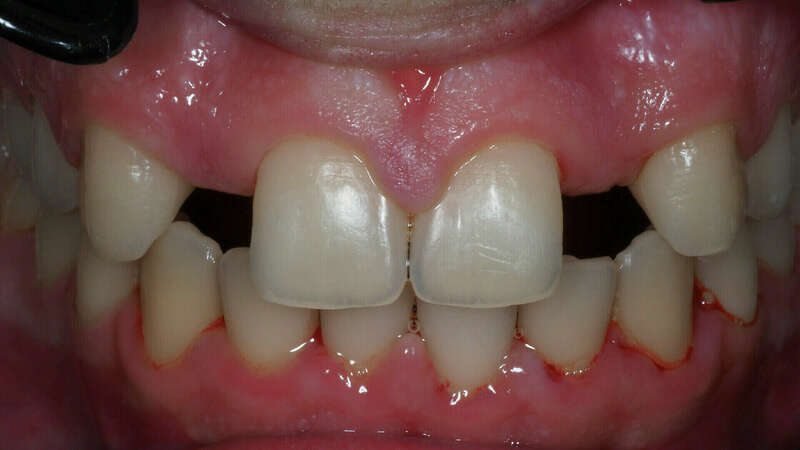  bridge cantilever AVANT