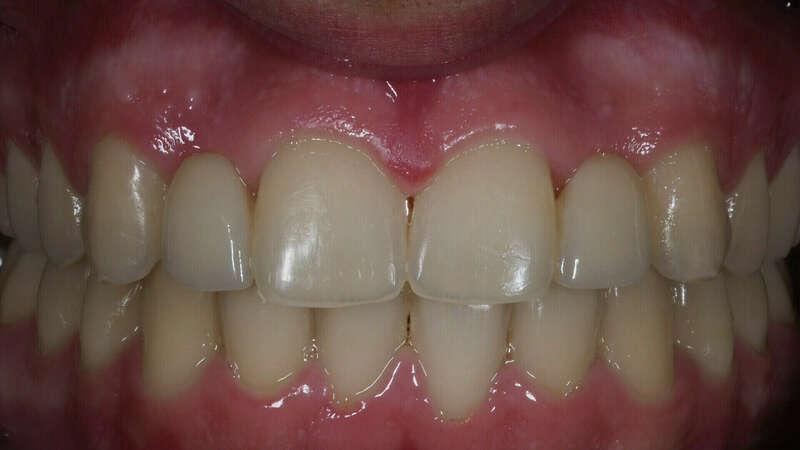  bridge cantilever après