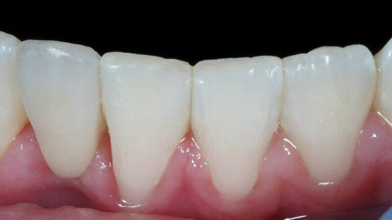  bridge cantilever après