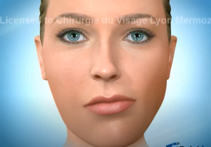 Chirurgie bimaxillaire