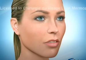 Disjonction maxillaire