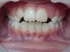 Cas clinique orthodontique, enfant