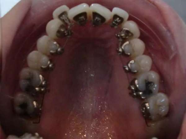 Qu’est-ce que l’orthodontie linguale invisible ?