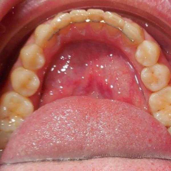 La contention orthodontique