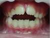 Cas clinique orthodontie Paris 8, béance