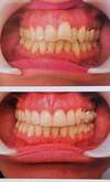 traitement orthodontique avant et après