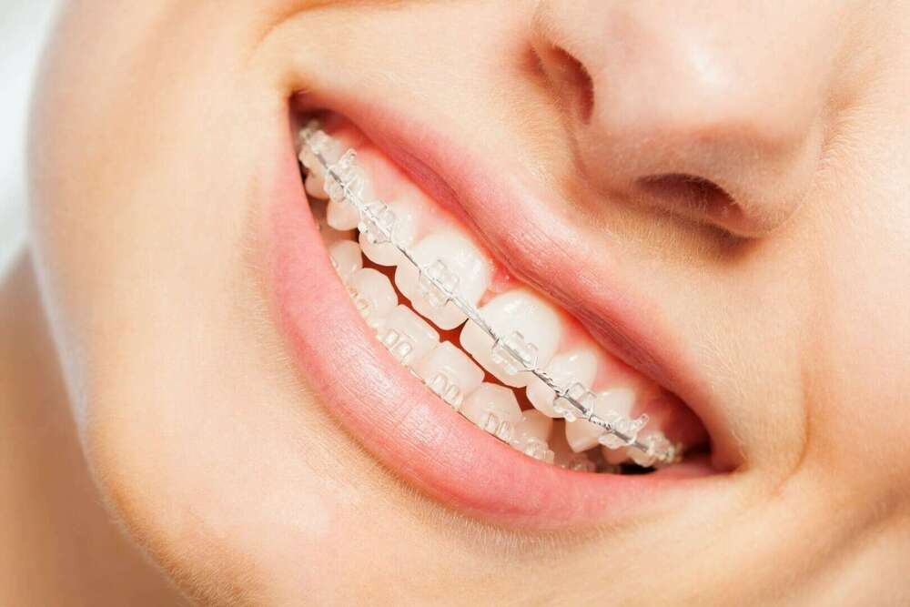 Conseils en cas d’incident avec un appareillage fixe (disjoncteur maxillaire ou quadhélix)
