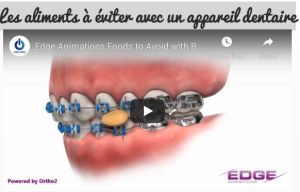 Les aliments à éviter avec un appareil dentaire