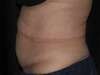 lipocavitation