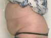 lipocavitation
