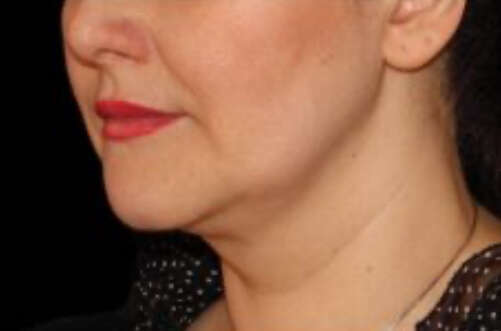 après traitement double menton