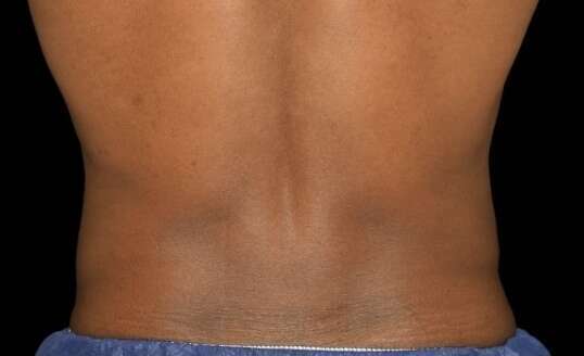 traitement poignée d'amour