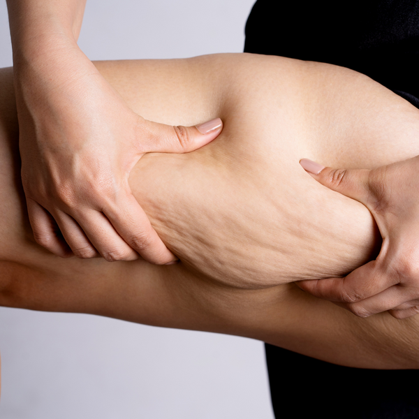 5 conseils professionnels pour réduire la cellulite efficacement 