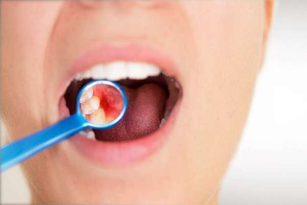 LE TRAITEMENT ET MAINTENANCE PARODONTALE