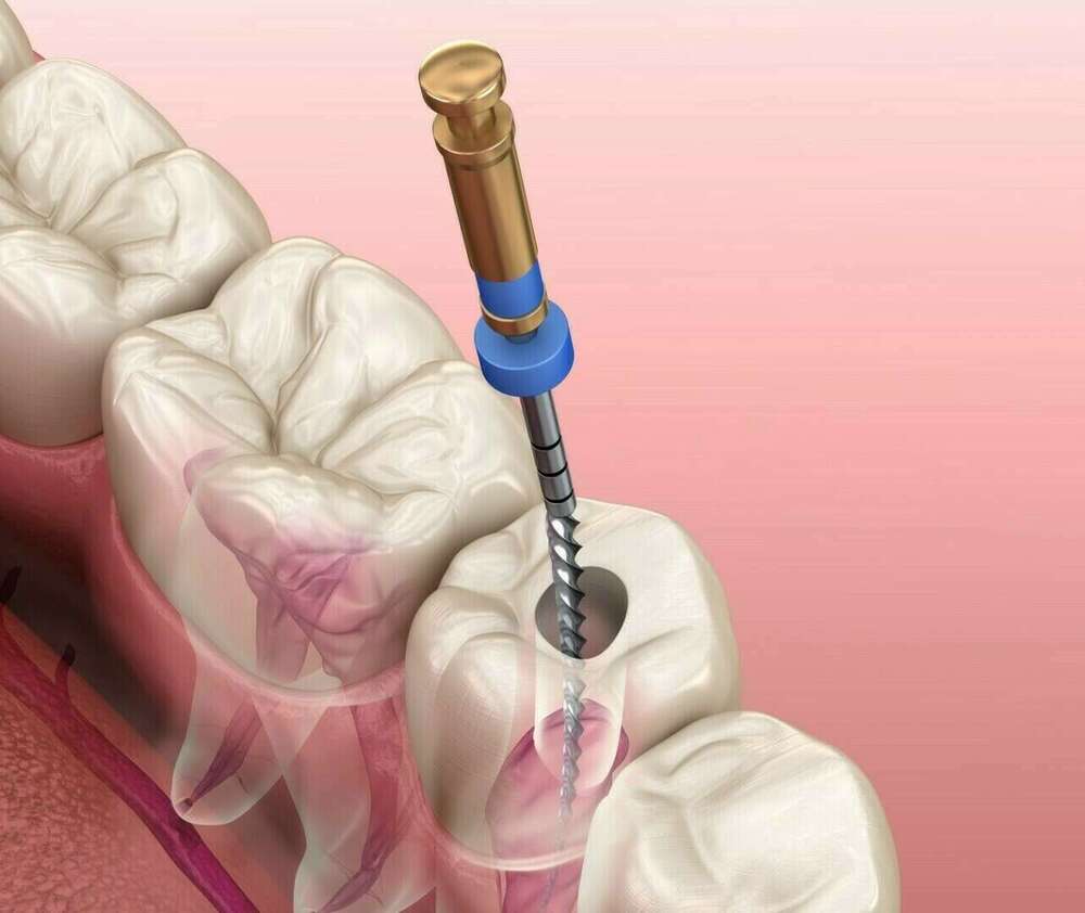 Le retraitement endodontique