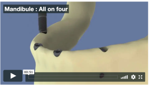 Mandibule : All on four