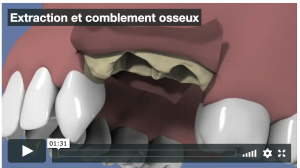 Extraction et comblement osseux