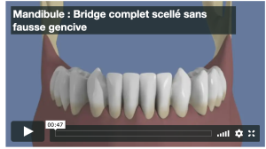 Mandibule : Bridge complet scellé sans fausse gencive