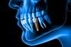 Qu'est-ce qu'un implant ? indications et contre-indications
