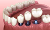 La pose d'implants dentaire