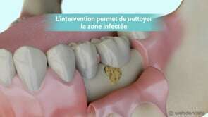 Régénération tissulaire guidée