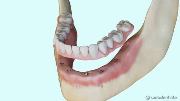 Prothèse complète vissée sur implant