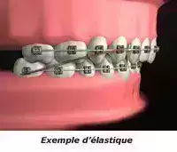 LES ELASTIQUE INTER-MAXILLAIRES