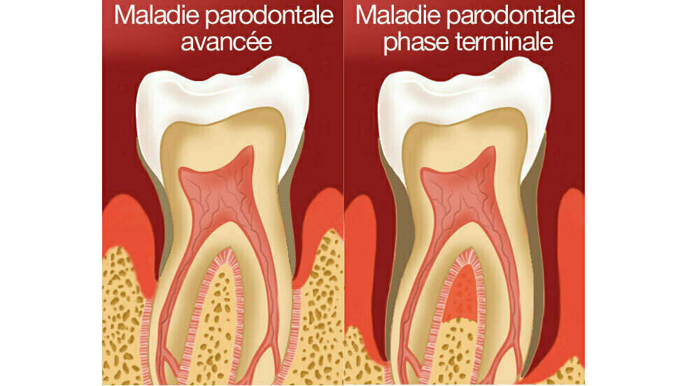 TRAITEMENT DES MALADIES PARODONTALES