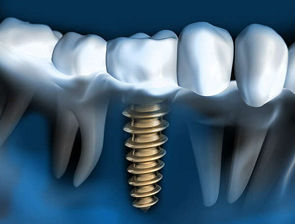 L'analyse pré-implantaire