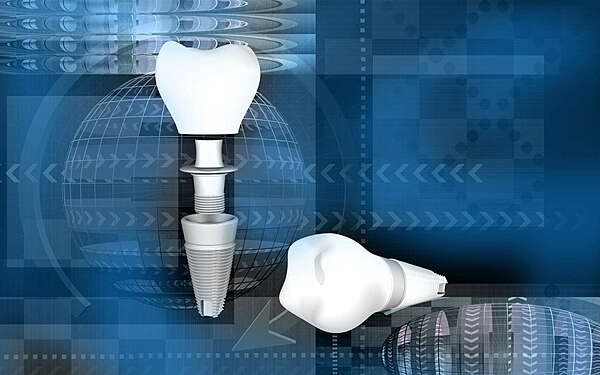 La maintenance implantaire