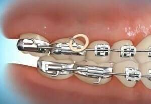 Correction avec élastique classe 3