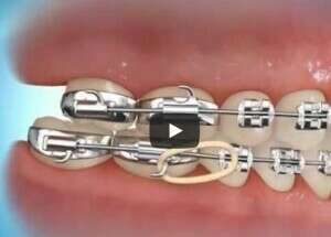 Correction avec élastique classe 2