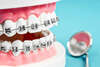 Mini-vis orthodontiques