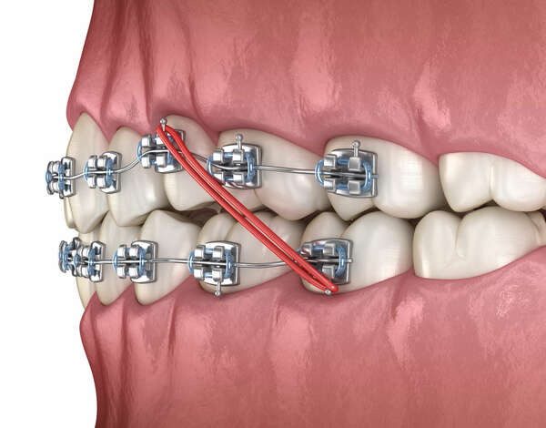 Les élastiques de Classe 2 avec des attaches orthodontiques