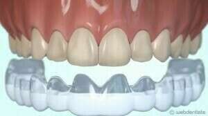 Blanchiment à la maison