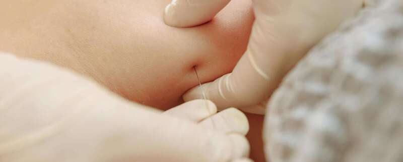 Dry Needling (puncture sèche)