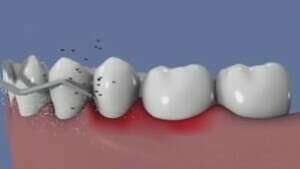 Traitement ultrasonique de la parodontite