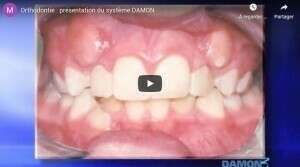 Orthodontie : Présentation du système DAMON
