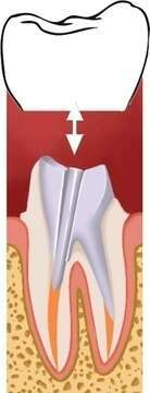 LES INLAY-CORE MARSEILLES 13008 : UNE ALTERNATIVE AU PLOMBAGE